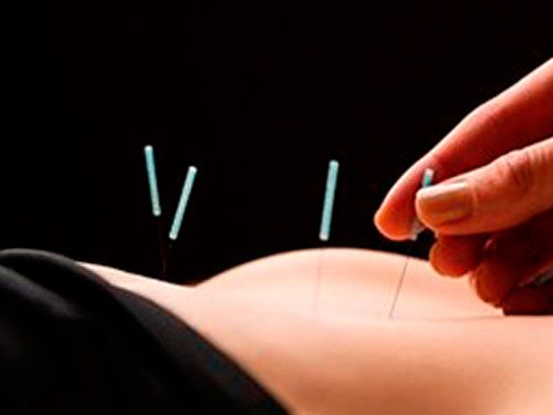 Fisalud Fisioterapia acupuntura